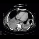 Pneumonia, liquefaction: CT - Computed tomography
